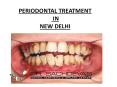 Laser Dentistry Training Course in Delhi PowerPoint PPT Presentation
