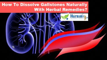 How To Dissolve Gallstones Naturally With Herbal Remedies?