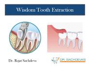 Wisdom Tooth Extraction | Dental Courses in India