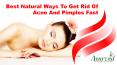Best Natural Ways To Get Rid Of Acne And Pimples Fast PowerPoint PPT Presentation