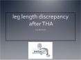 leg length discrepancy after THA PowerPoint PPT Presentation