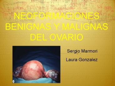 NEOFORMACIONES BENIGNAS Y MALIGNAS DEL OVARIO