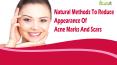Natural Methods To Reduce Appearance Of Acne Marks And Scars PowerPoint PPT Presentation