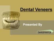 Dental Veneers