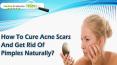 How To Cure Acne Scars And Get Rid Of Pimples Naturally? PowerPoint PPT Presentation