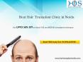 Get your hair transplant treatment done at discounted rates Contact HOS 9911170709