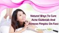 Natural Ways To Cure Acne Outbreak And Remove Pimples On Face PowerPoint PPT Presentation