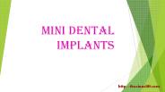 mini dental implants