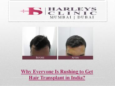 Why Everyone Is Rushing to Get Hair Transplants?