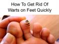 How To Get Rid Of Warts on Feet Quickly PowerPoint PPT Presentation