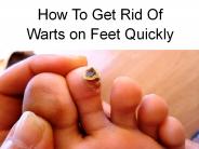 How To Get Rid Of Warts on Feet Quickly