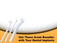 Get These Great Benefits with Your Dental Implants