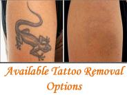 Available Tattoo Removal Options