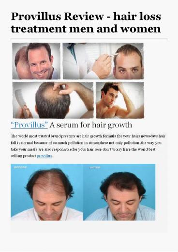 Provillus Review – hair loss treatment men and women