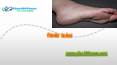 Cracked Feet - Symptoms,Causes,Treatment PowerPoint PPT Presentation