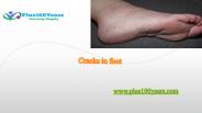 Cracked Feet - Symptoms,Causes,Treatment