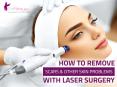 How to Remove Scars and Other Skin Problems with Laser Surgery PowerPoint PPT Presentation