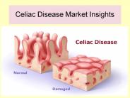 Celiac Disease Market Reports