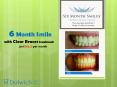 6 Month Smile with Clear Braces Treatment Just £46.2 per Month PowerPoint PPT Presentation