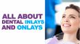 All About Dental Inlays and Onlays PowerPoint PPT Presentation