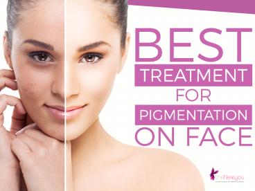 Best Treatment for Pigmentation on Face