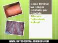Como Eliminar los Hongos Genitales por Candida Albicans Tratamiento Natural PowerPoint PPT Presentation