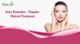 Acne Remedies - Pimples Natural Herbal Treatment