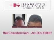 Hair Transplant Scars – Are They Visible?