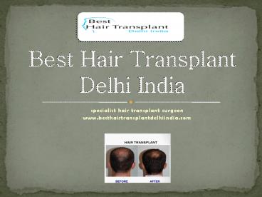 Best Hair Transplant FUE, FUT, Eyebrow Delhi, Hair Loss Treatment India