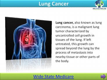 Lung Cancer Treatment: WideStateMedicare
