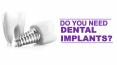 Do You Need Dental Implants PowerPoint PPT Presentation