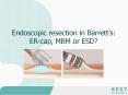 Endoscopic resection in Barrett PowerPoint PPT Presentation