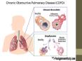 Chronic Obstructive Pulmonary Disease: A Comprehensive Case Study PowerPoint PPT Presentation
