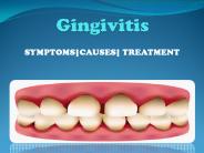 Gingivitis (Mild Gum Disease)
