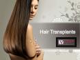 Hair Transplant PowerPoint PPT Presentation