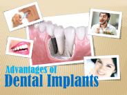 9 benefits of dental implants