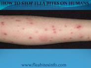 Flea Bites - Symptoms, Prevention & Treatment