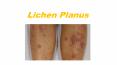 Lichen planus - complete knowledge PowerPoint PPT Presentation