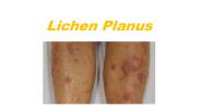 Lichen planus - complete knowledge