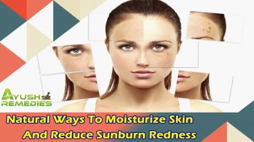 Natural Ways To Moisturize Skin And Reduce Sunburn Redness