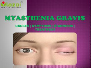 Myasthenia Gravis: Symptoms, Causes, diagnosis and treatment.