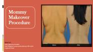 Mommy Makeover Procedure