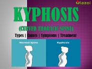 Kyphosis: Curved Thoracic Spine