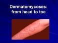Dermatomycoses: from head to toe PowerPoint PPT Presentation
