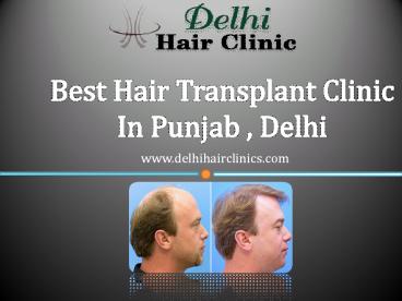 Get natural hair with hair transplant clinic in Punjab,Delh
