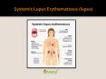 Systemic lupus erythematosus (lupus): Disease of the immune system PowerPoint PPT Presentation