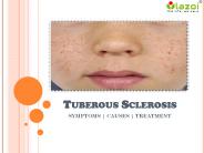 Tuberous Sclerosis : Causes, Symptoms, Diagnosis, Prevention and Treatment