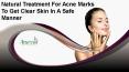 Natural Treatment For Acne Marks To Get Clear Skin In A Safe Manner PowerPoint PPT Presentation