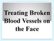 Treating Broken Blood Vessels on the Face