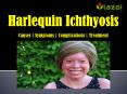 Harlequin Ichthyosis: Causes, symptoms, complications and treatment. PowerPoint PPT Presentation